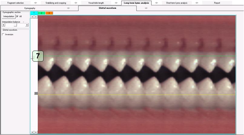 Kymographic analysis window – Long-term kymo analysis -> Glottal waveform; determining the range of the glottis opening 